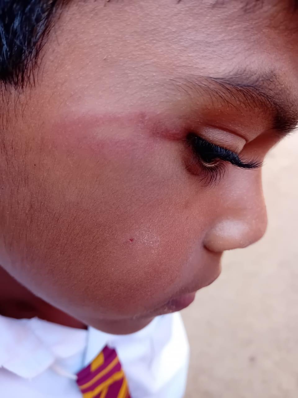 ஆசிரியரின் தாக்குதலுக்குள்ளான மாணவன் வைத்தியசாலையில் அனுமதி !